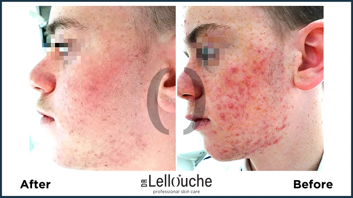 תמונה לפני ואחרי טיפול באקנה