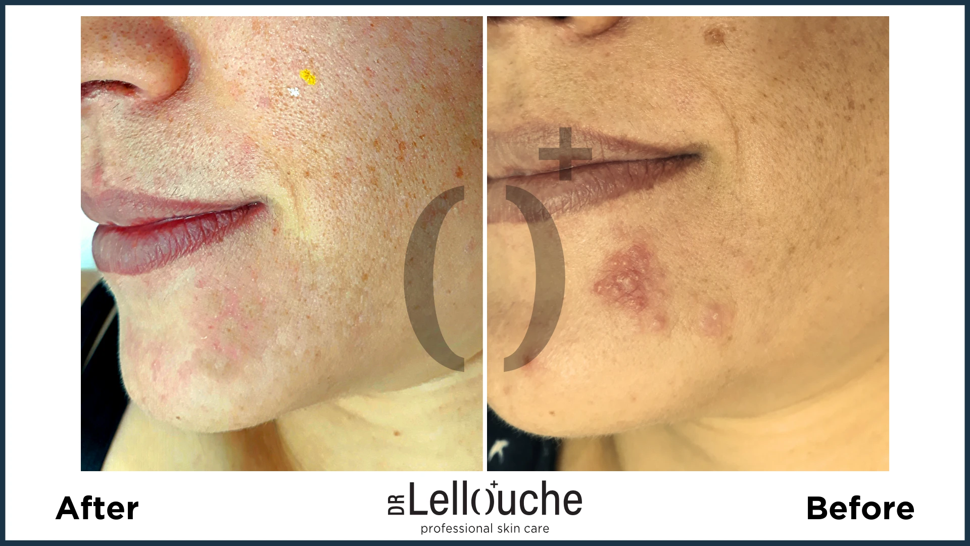 תמונה לפני ואחרי טיפול ברוזציאה