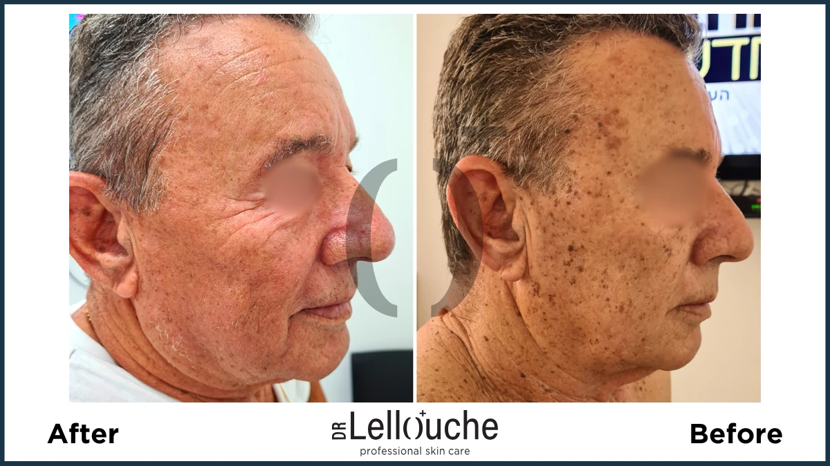 תמונה לפני ואחרי טיפול להסרת נגעים