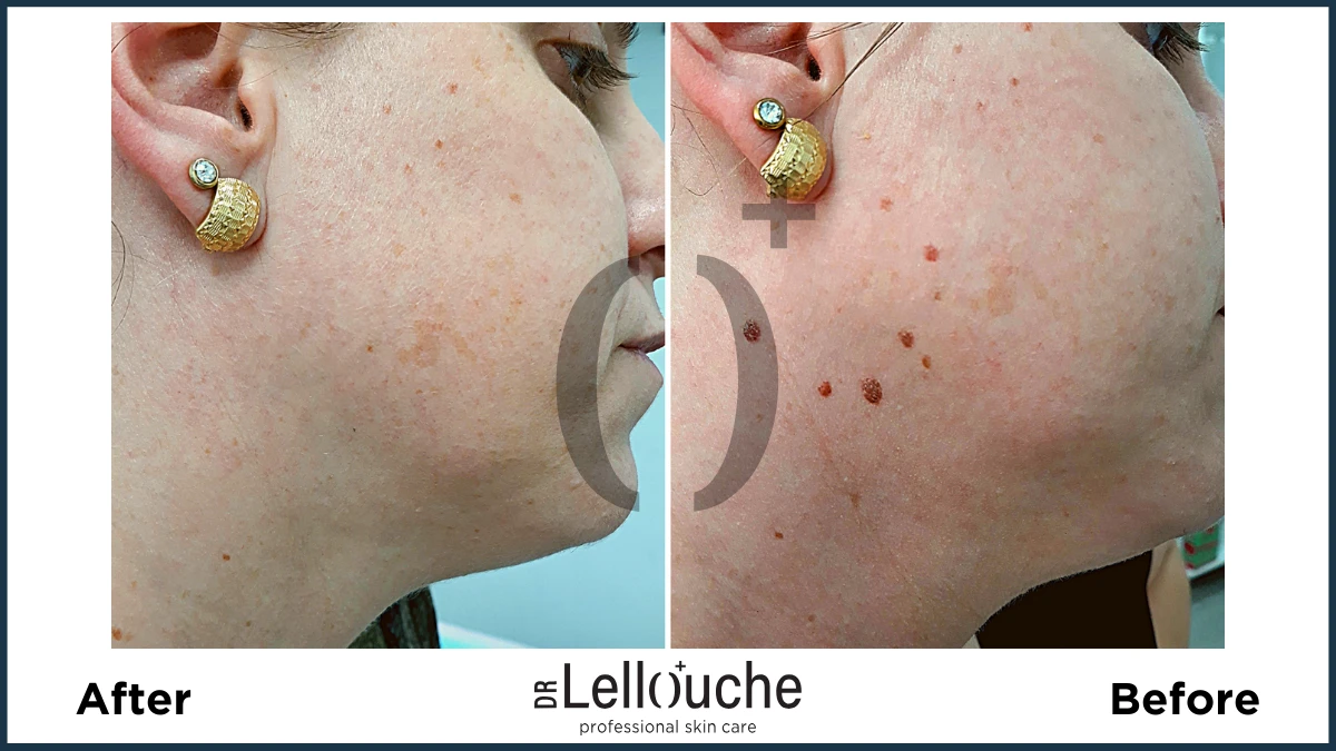 תמונה לפני ואחרי טיפול להסרת נגעים