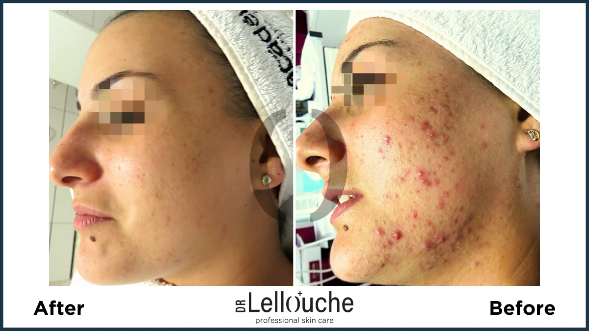 תמונה לפני ואחרי טיפול באקנה