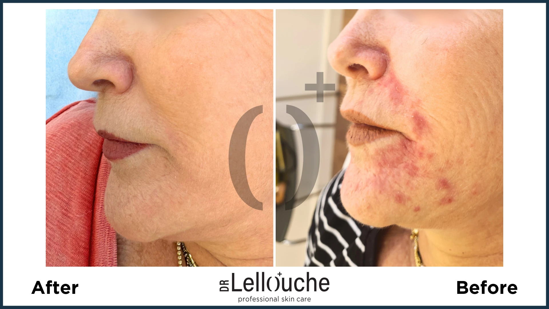 תמונה לפני ואחרי טיפול ברוזציאה