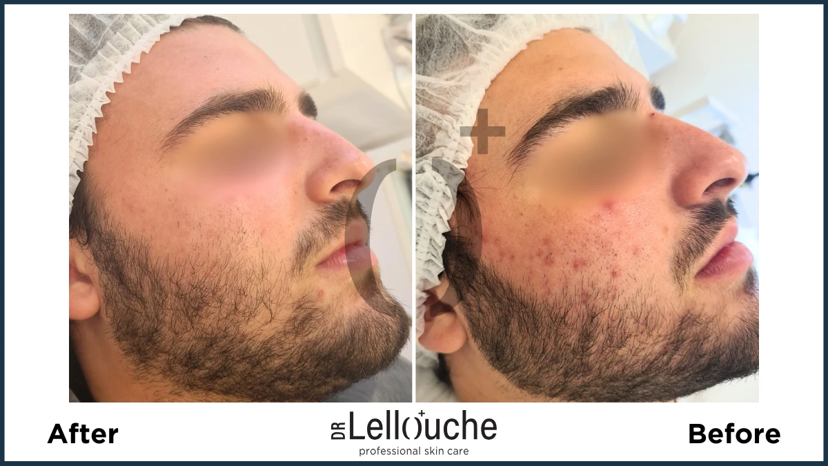 תמונה לפני ואחרי טיפול באקנה