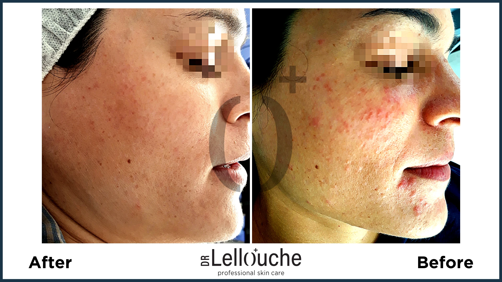 תמונה לפני ואחרי טיפול ברוזציאה