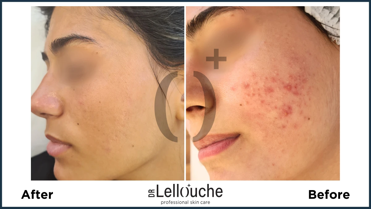 תמונה לפני ואחרי טיפול באקנה