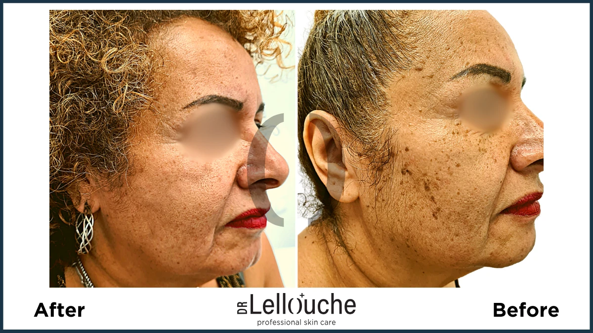 תמונה לפני ואחרי טיפול להסרת נגעים