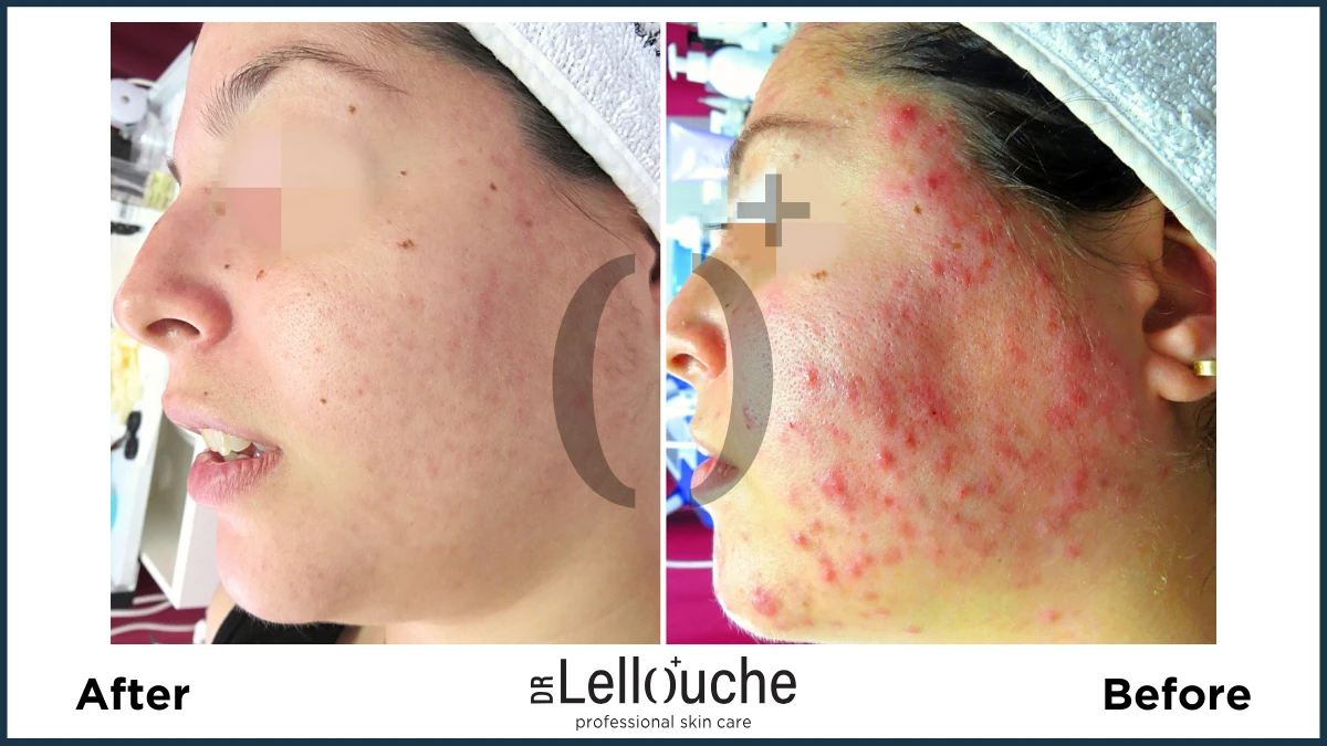 תמונה לפני ואחרי טיפול באקנה