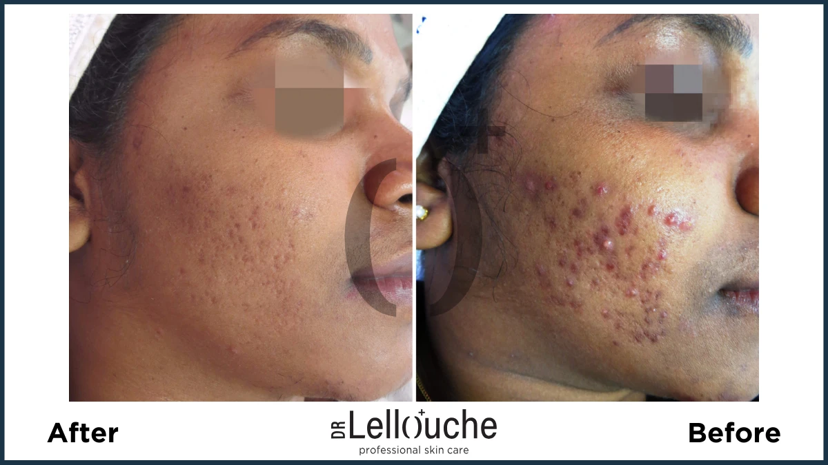 תמונה לפני ואחרי טיפול באקנה