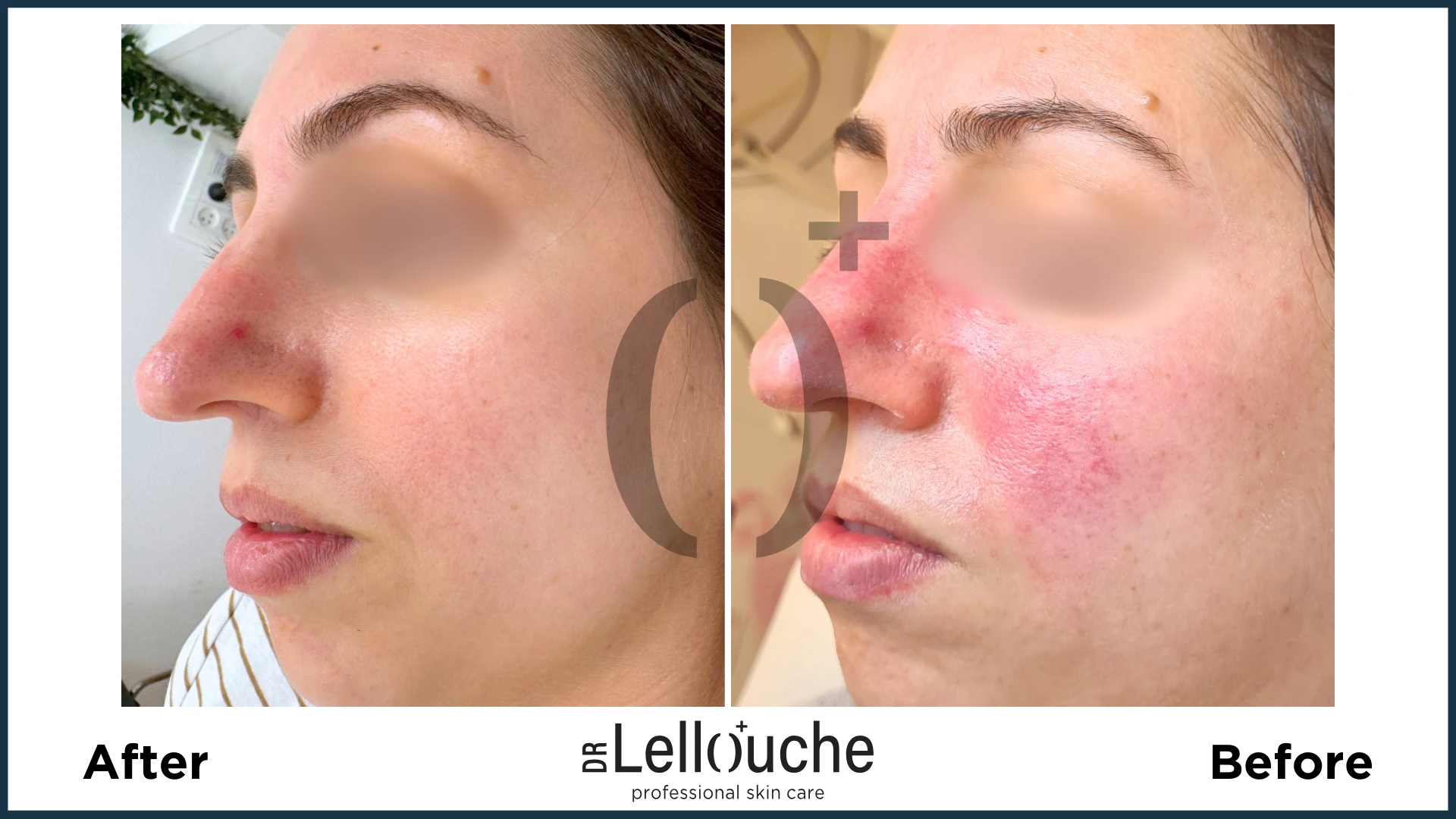 תמונה לפני ואחרי טיפול ברוזציאה