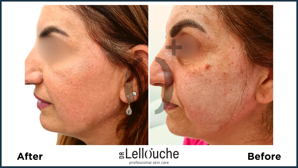 תמונה לפני ואחרי טיפול להסרת נגעים