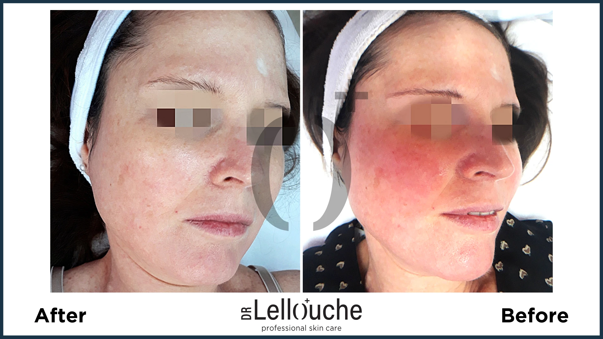 תמונה לפני ואחרי טיפול ברוזציאה