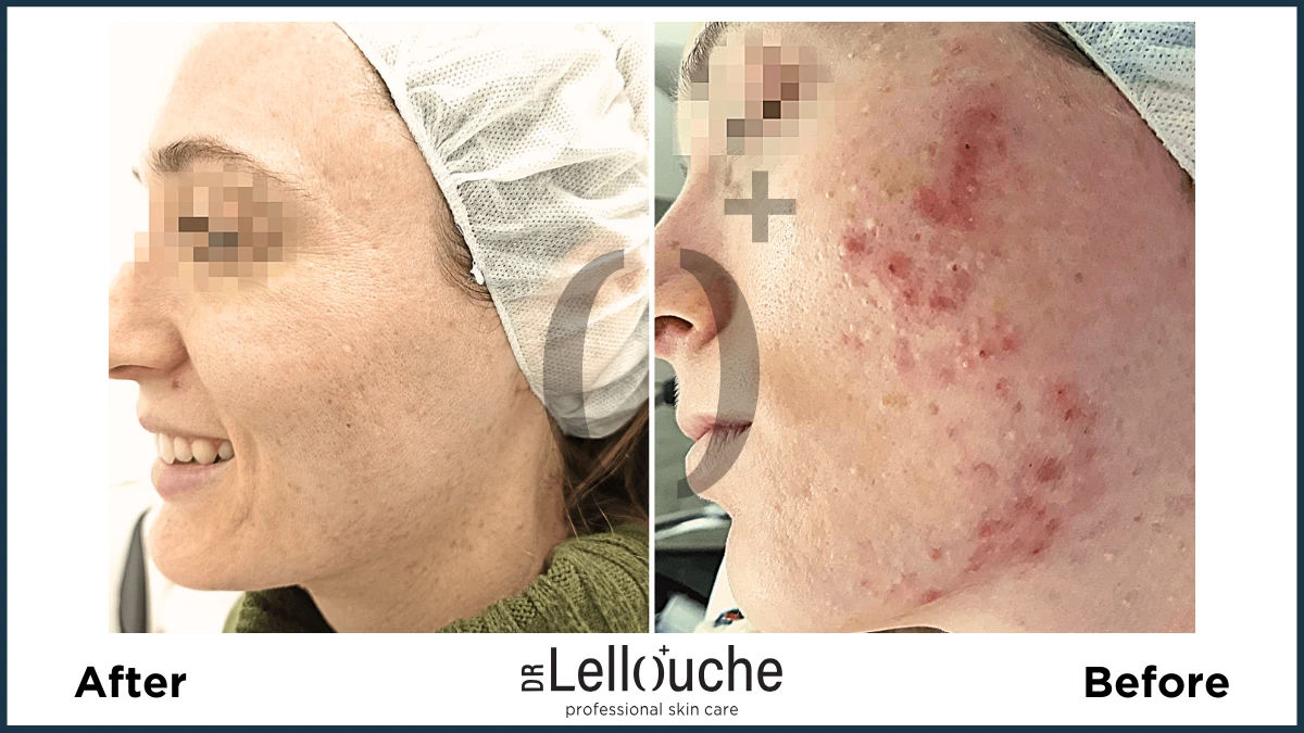 תמונה לפני ואחרי טיפול באקנה