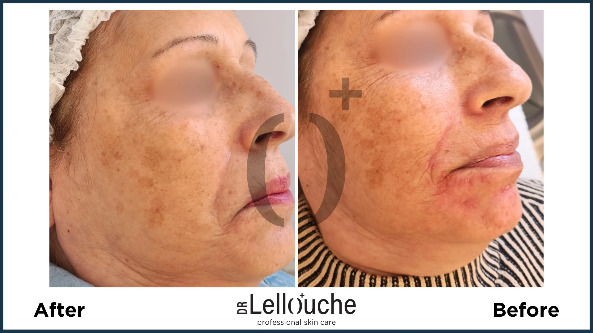 תמונה לפני ואחרי טיפול ברוזציאה