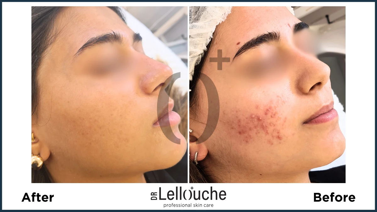 תמונה לפני ואחרי טיפול באקנה