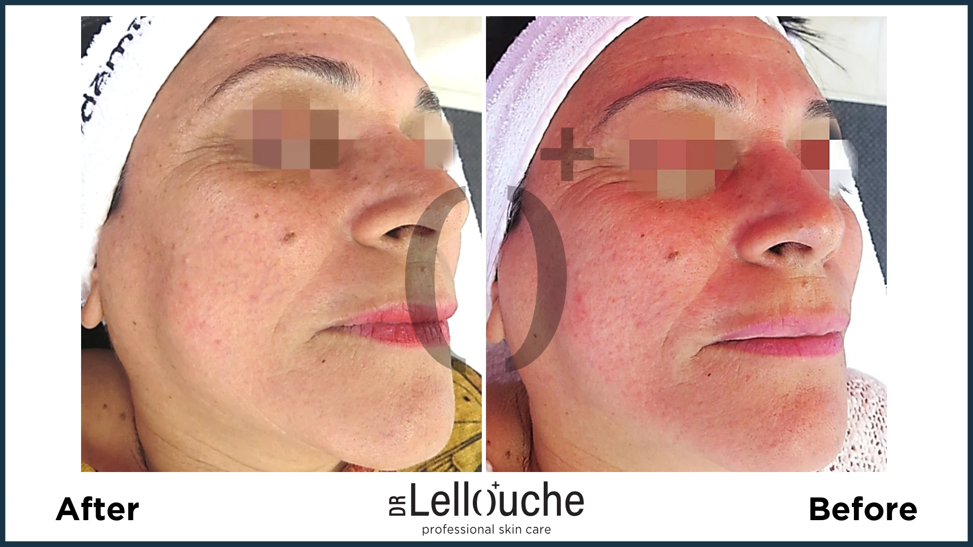 תמונה לפני ואחרי טיפול ברוזציאה