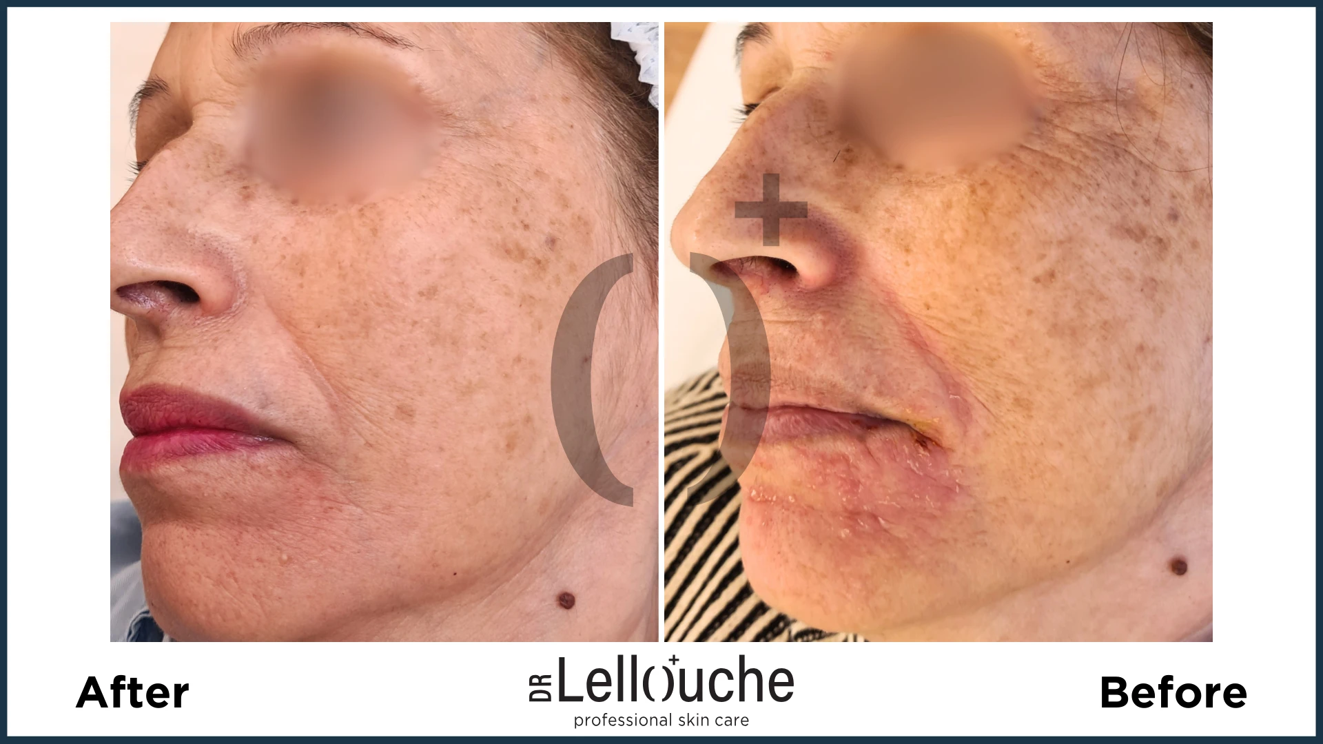 תמונה לפני ואחרי טיפול ברוזציאה