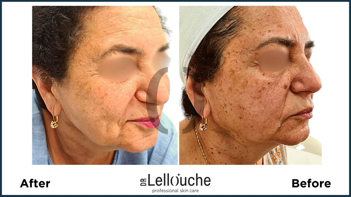 תמונה לפני ואחרי טיפול להסרת נגעים