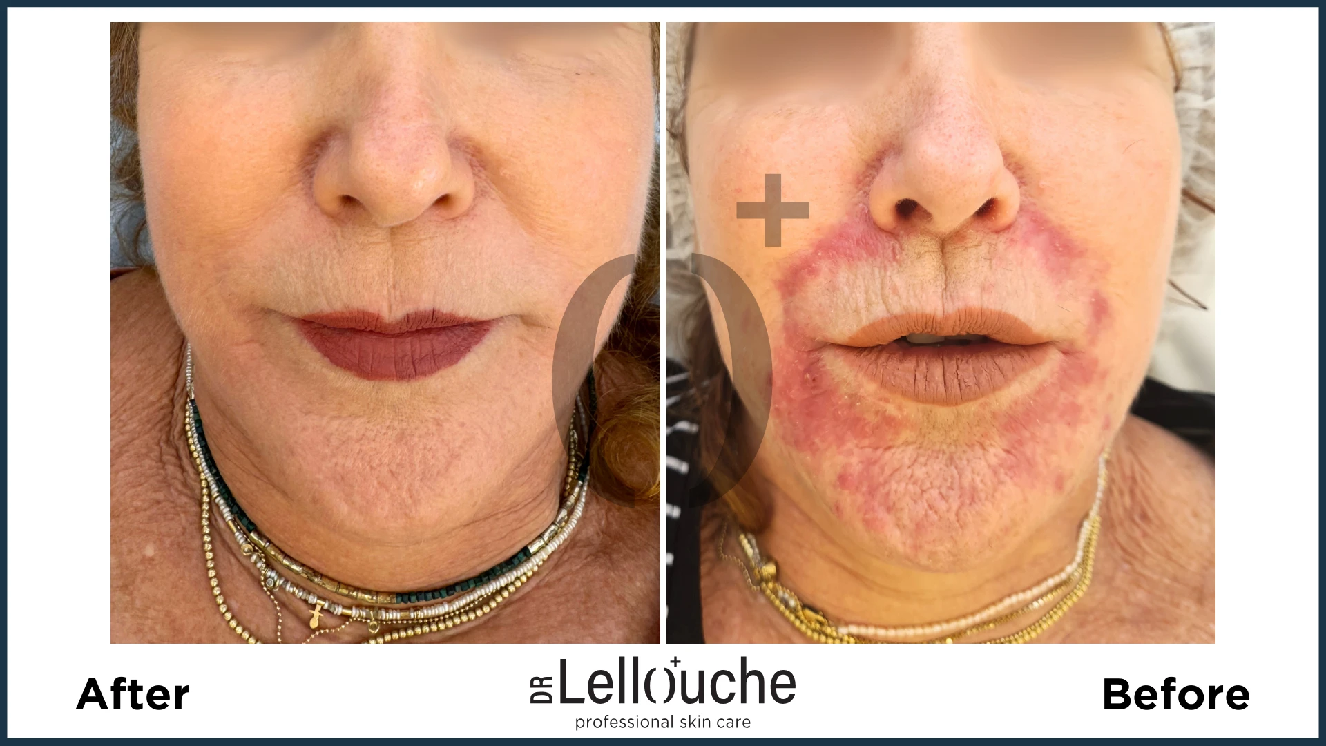 תמונה לפני ואחרי טיפול ברוזציאה