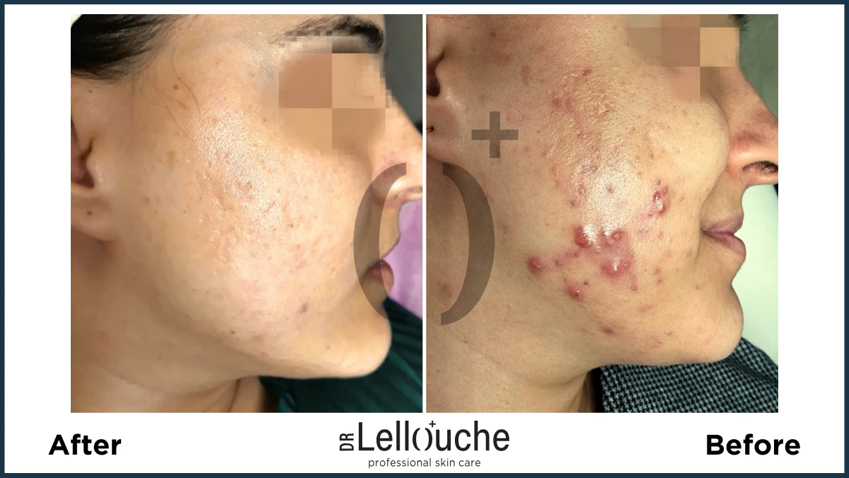 תמונה לפני ואחרי טיפול באקנה