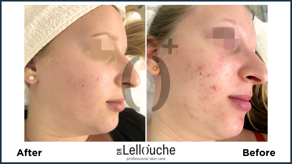 תמונה לפני ואחרי טיפול באקנה