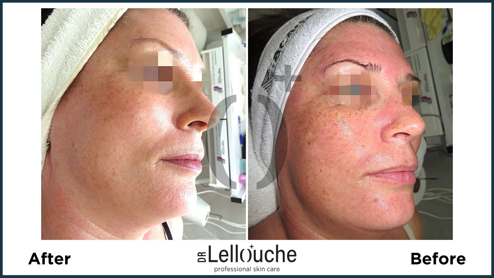 תמונה לפני ואחרי טיפול ברוזציאה