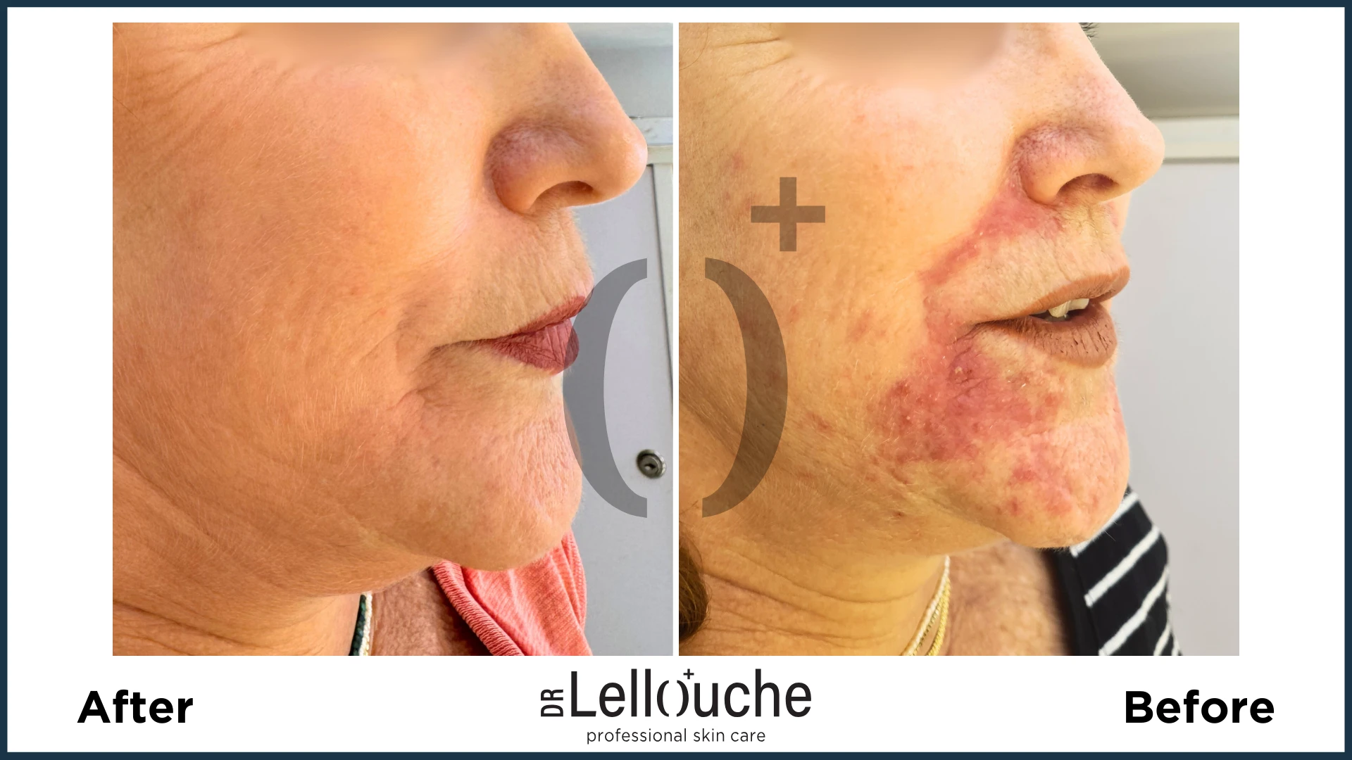 תמונה לפני ואחרי טיפול ברוזציאה