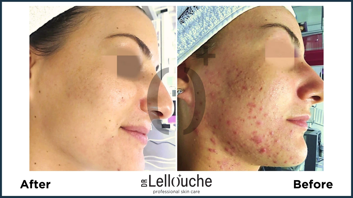 תמונה לפני ואחרי טיפול באקנה