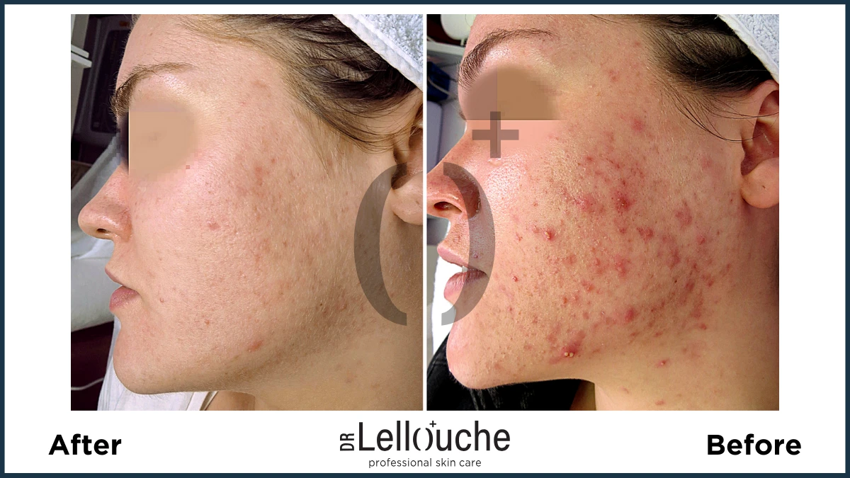 תמונה לפני ואחרי טיפול באקנה