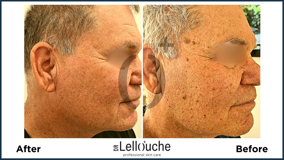 תמונה לפני ואחרי טיפול להסרת נגעים