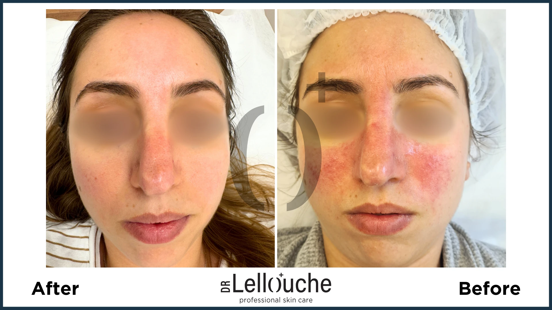 תמונה לפני ואחרי טיפול ברוזציאה